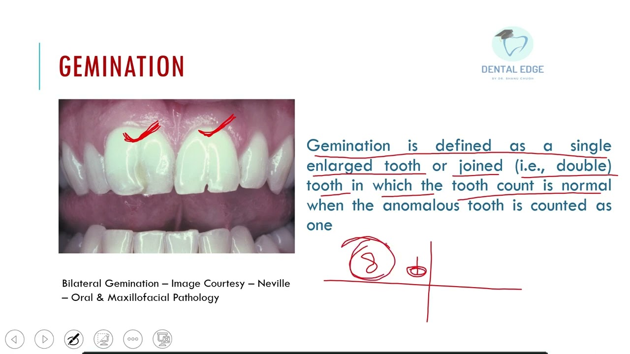 Gemination I Twinning I Developmental Disturbances of Teeth
