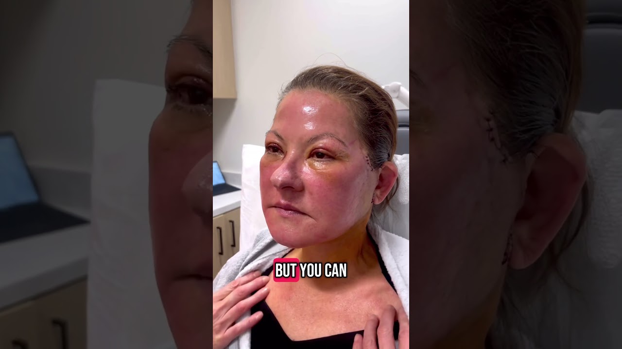 Necklift Results - 5 Days Post-op