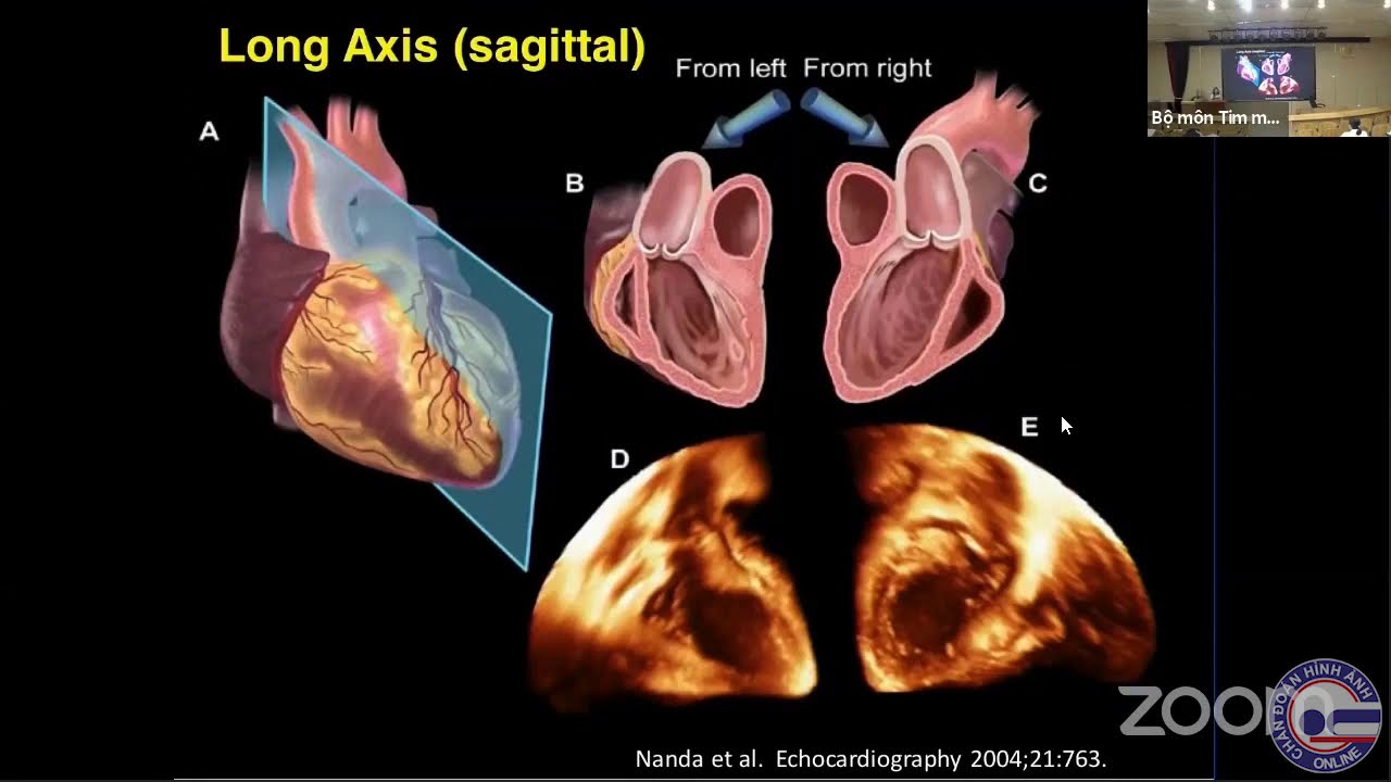 #16 Siêu âm tim 3D real time, TS.BS. Nguyễn Thị Thu Hoài
