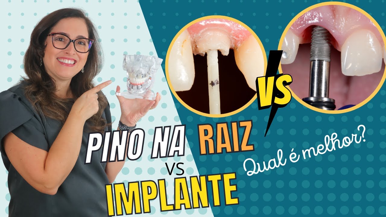 Pino na raiz ou implante? Adornare Odontologia em Santos