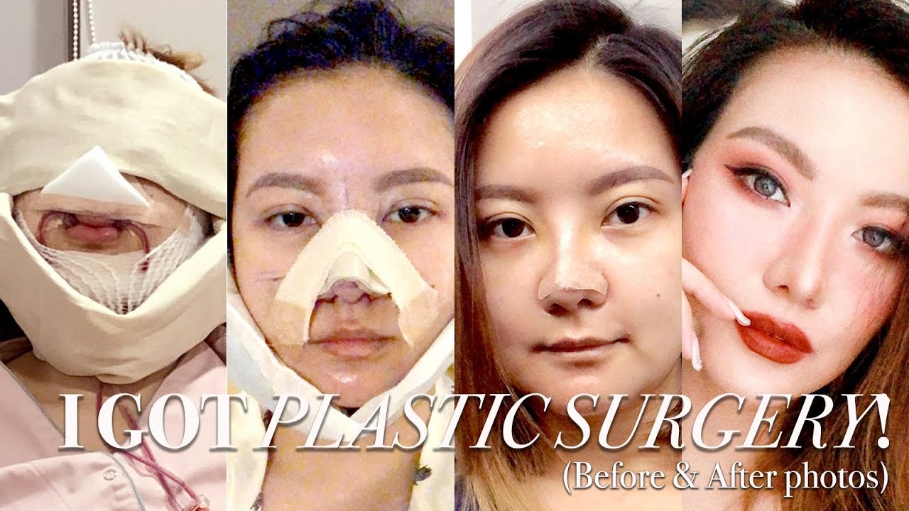 I Got Plastic Surgery in Korea: Part 2 ⎮BEFORE & AFTER, SURGERY, RECOVERY ⎮Emily Quak