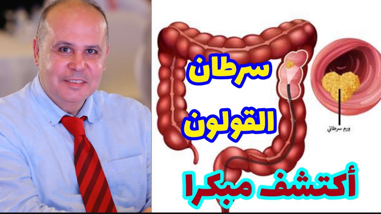 علامات في جسمك تخبرك بسرطان القولون