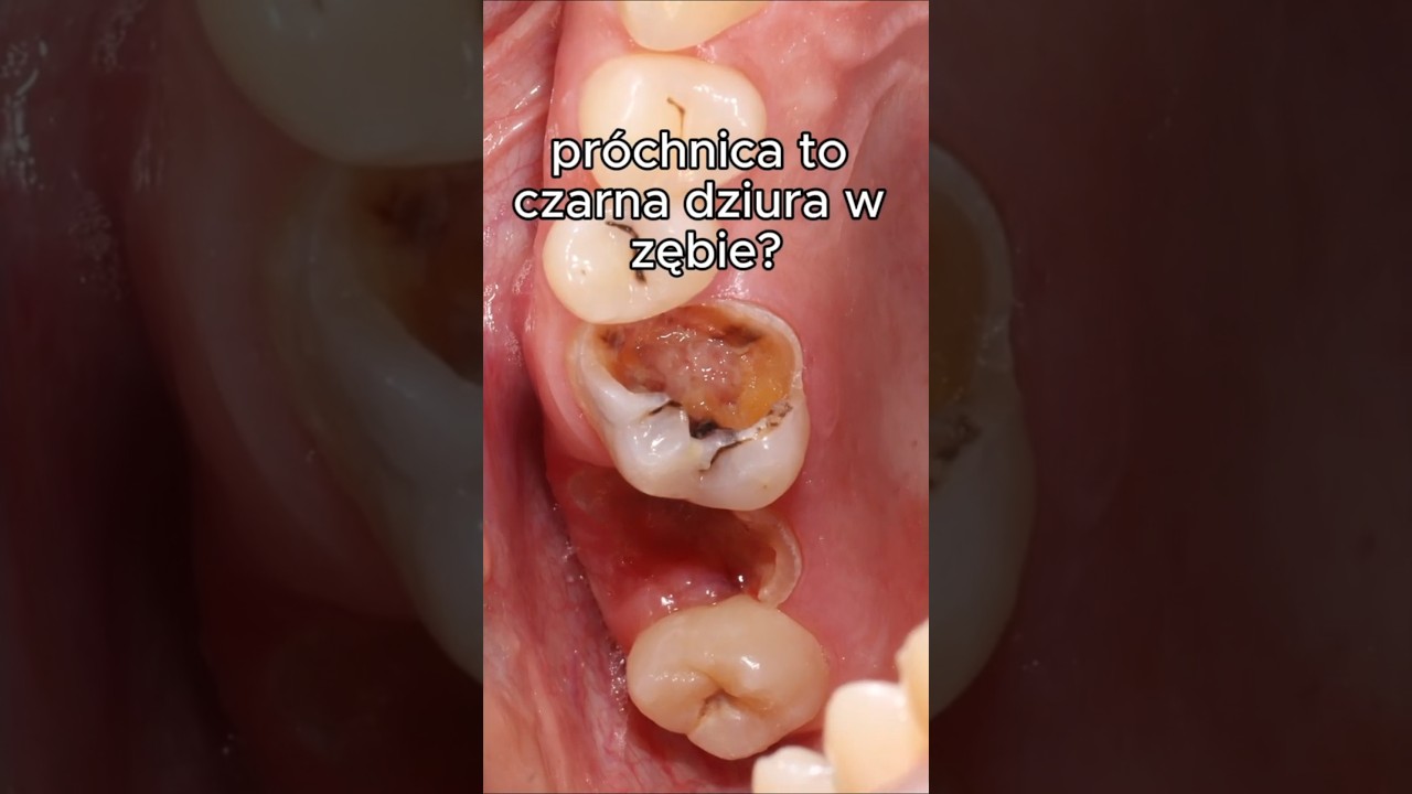 Ząb też potrzebuje regeneracji. #stomatologia #dentysta #dentist #zęby #pr&oacute;chnica