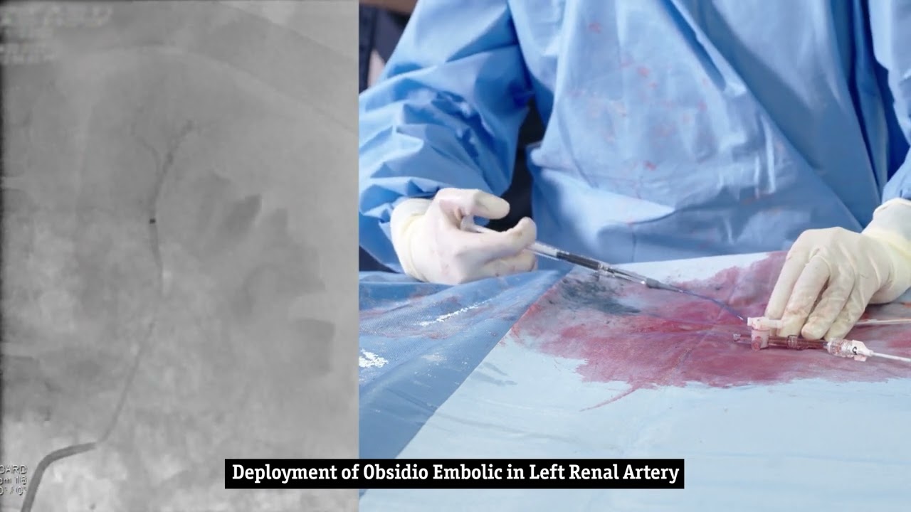 Obsidio&trade; Conformable Embolic pre-clinical embolization procedure in the left renal artery