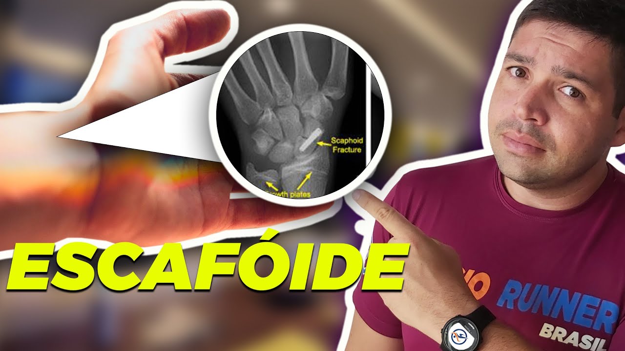 FRATURA DE ESCAFÓIDE  - conheça o Tratamento e o tempo de recuperação da Fratura do Escafoide