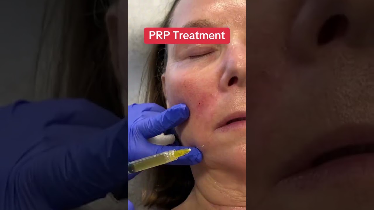 How a PRP Treatment Works #prp #prf #wrinkletreatment