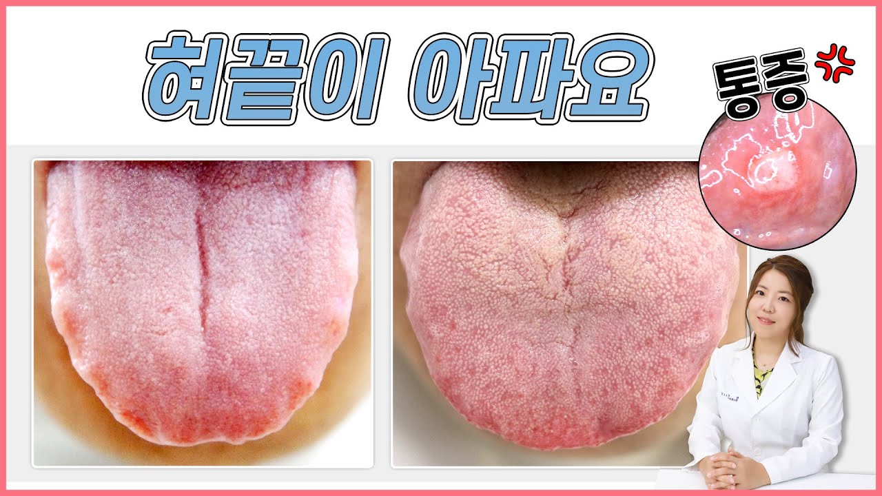 혀끝이 아파요! 혀끝 통증 3가지 원인: 구내염, 치흔, 구강작열감증후군