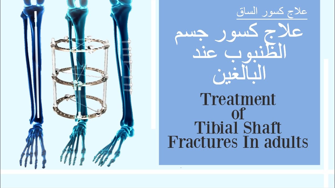 علاج كسور جسم الظنبوب عند البالغين - علاج كسور قصبة الساق  Treatment of Tibial Fractures In adults
