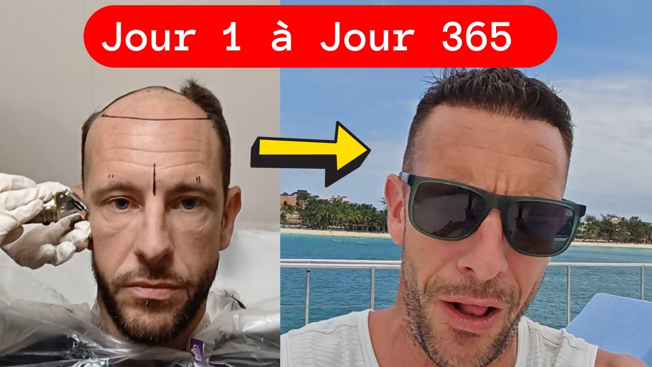🟢Greffe de cheveux : &eacute;volution mois par mois photo pendant 1 an Implants 12 Mois apr&egrave;s [Time-Lapse]
