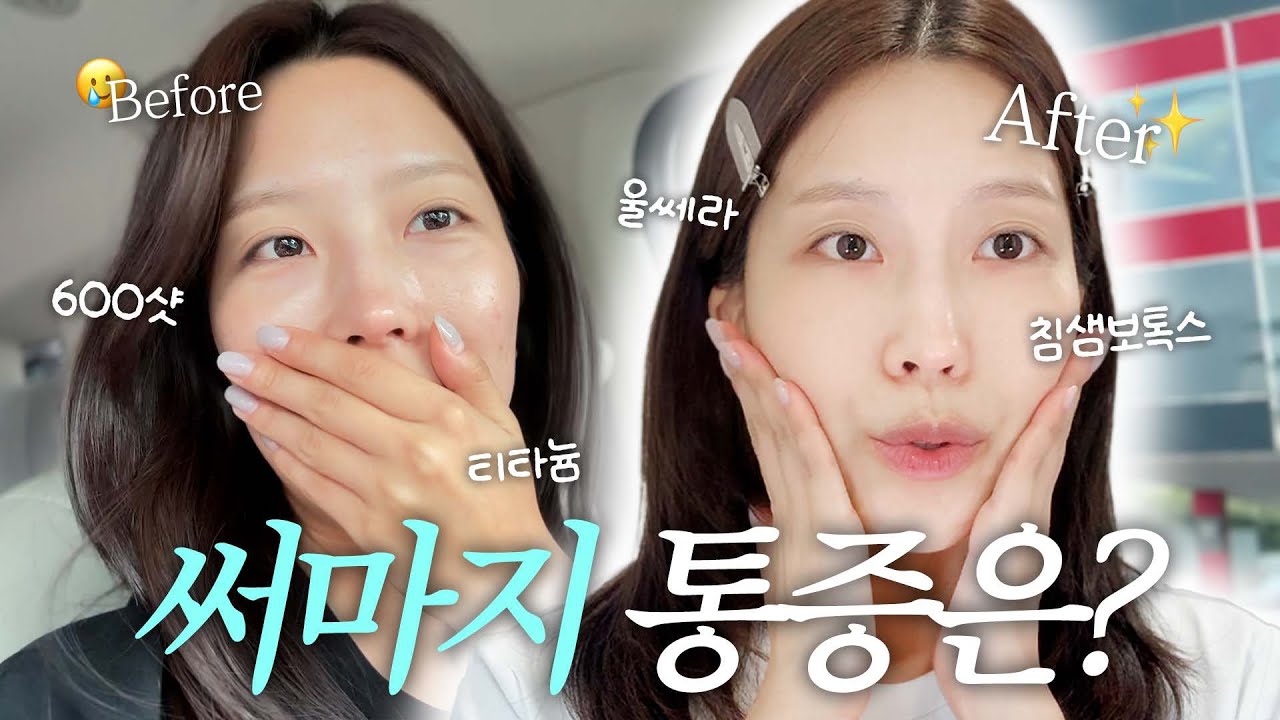 부부끼리 써마지+울쎄라 받은 리얼 후기⭐️(통증·효과 솔직 리뷰)