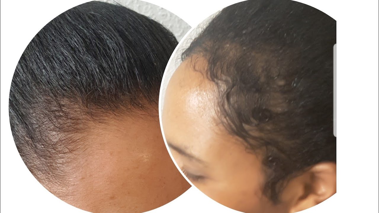 ከፍት የሸሸ ፀጉሬን በ4ወር እንዴት እያሰደኩ እንደለሁ