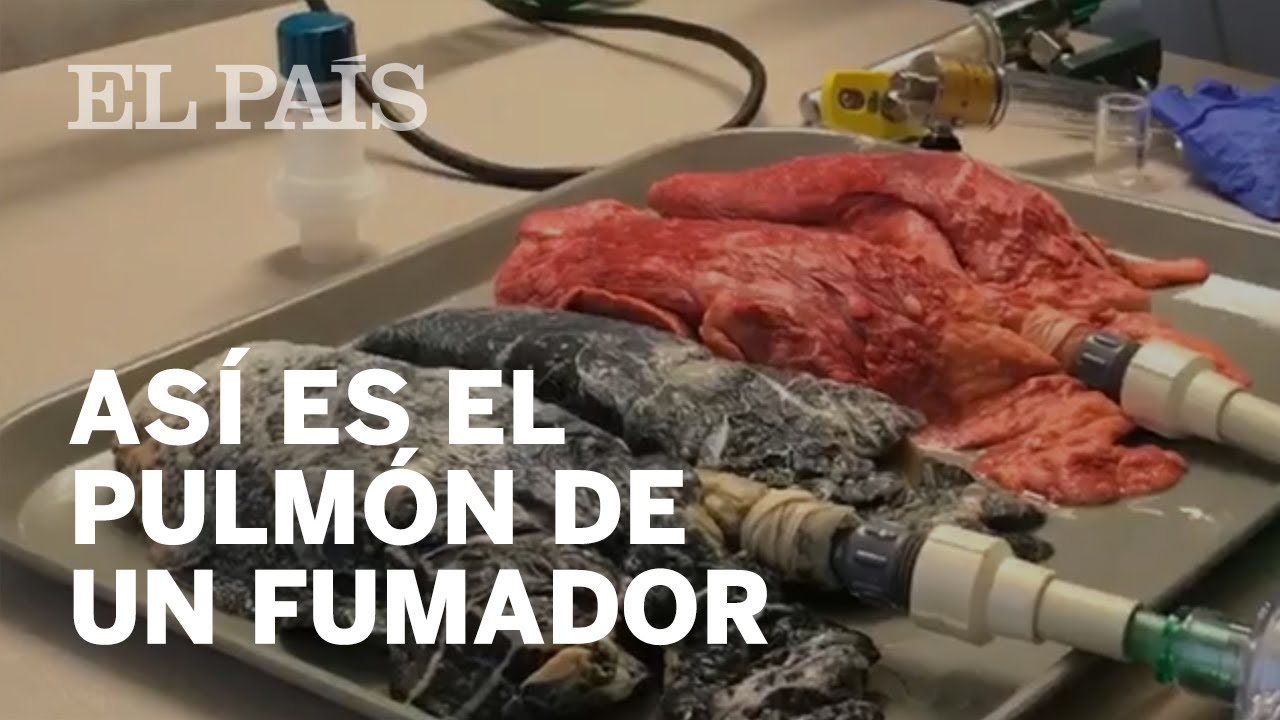 As&iacute; se transforma el pulm&oacute;n de un fumador