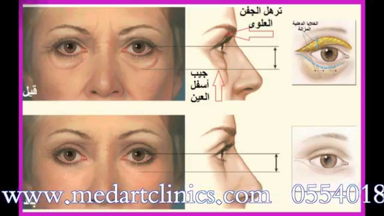 د.جمال جمعه - بانوراما fm تجميل الجفون و توسيع العيون