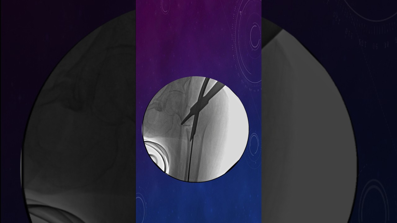 Complex trochanteric fracture nailed in few minutes. #ortho #nailing #trauma #hip #fracture