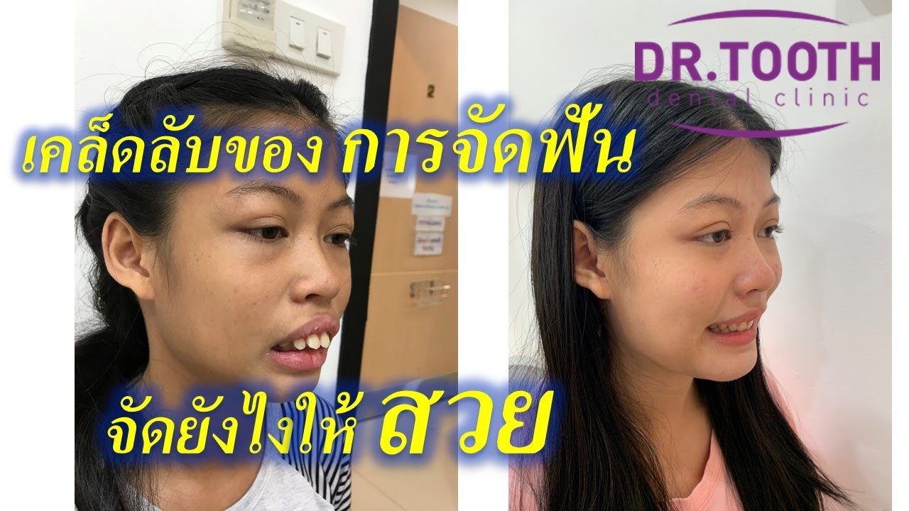 เคล็ดลับ !! จัดฟันยังไงให้ออกมาสวย เรามีเคล็ดลับง่ายๆมาบอก #จัดฟันที่ไหนดี #จัดฟันครั้งแรก #จัดฟัน 