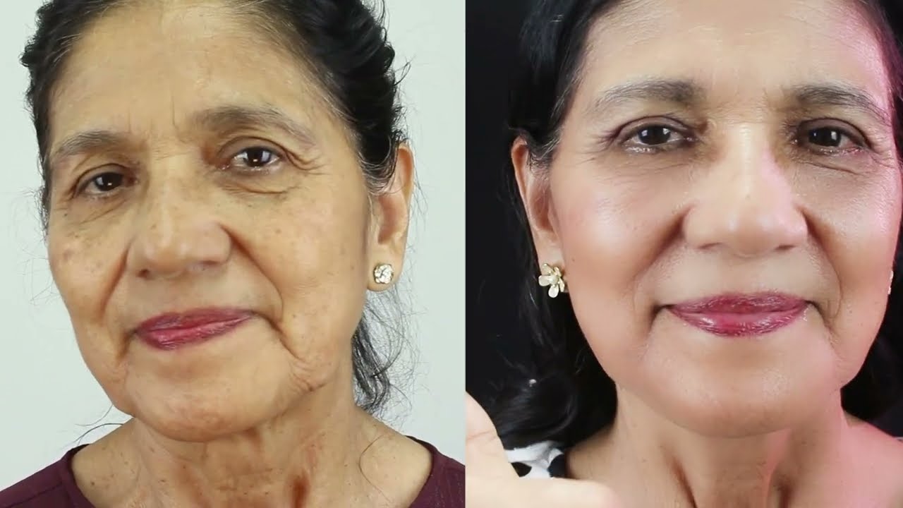 REJUVENECIMIENTO Facial ANTES y DESPUES 💕  MINILIFTING y BLEFAROPLASTIA 🧡 Dr Percy Nevado CIRUGÍA