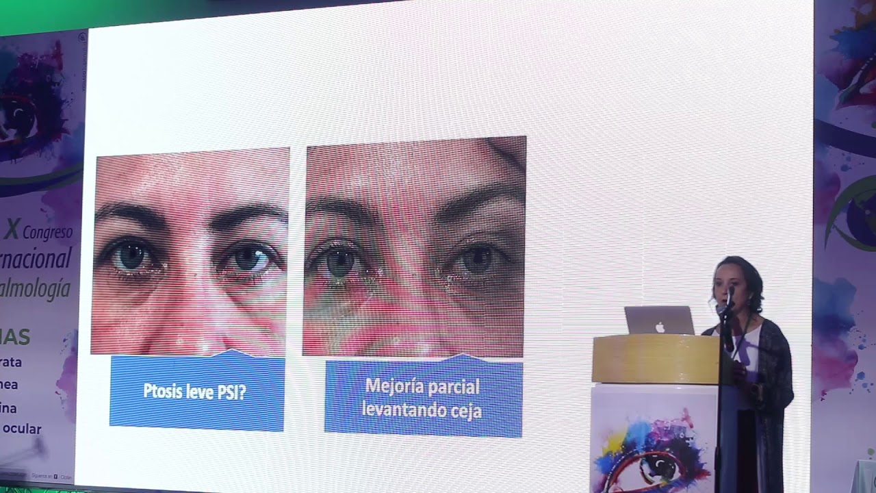 Ptosis palpebral: correcto vs. fácil, Dra. Ana María Mejía