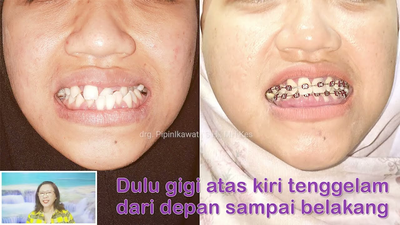 12 bulan perawatan behel gigi berantakan, behel gigi cameh, behel gigi maju mundur dokter gigi Jogja
