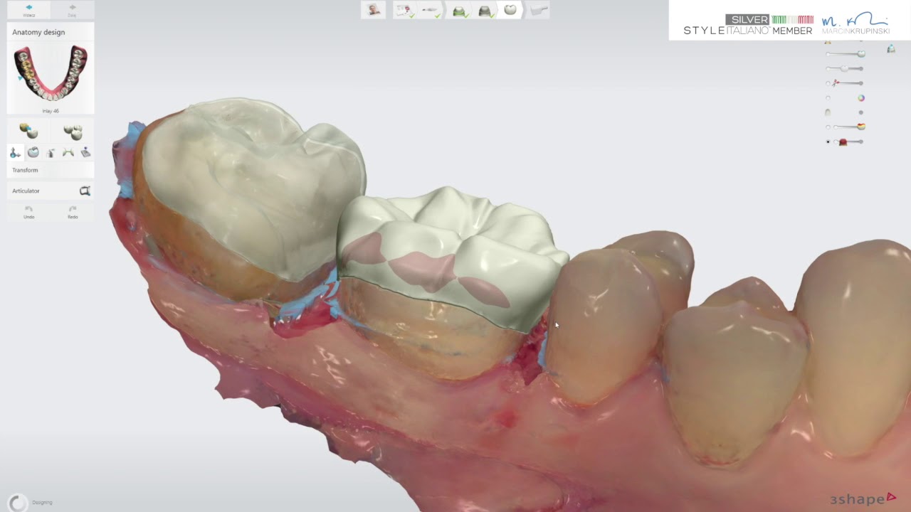 cerasmart onlays with Trios 3 scanner