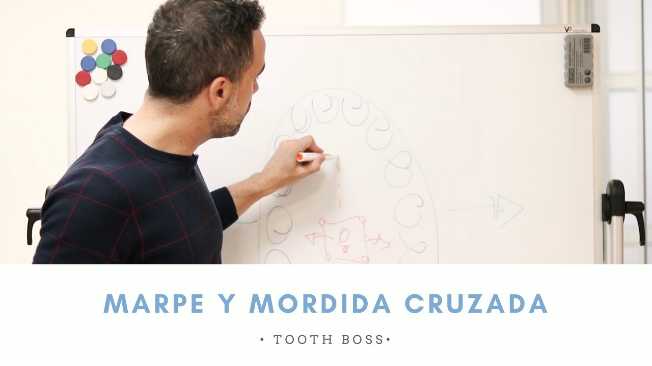 TOOTH BOSS || MARPE. Mordida cruzada en pacientes adultos || Ortodoncia en Murcia