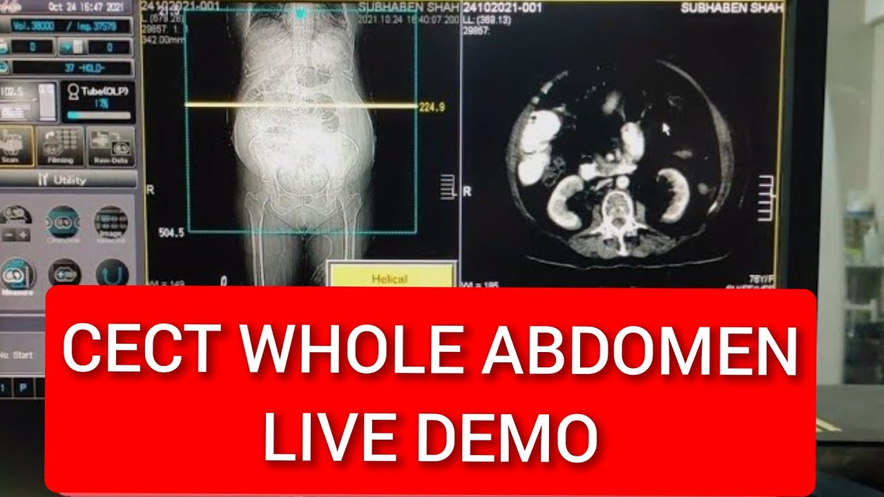 How to do CECT Abdomen.