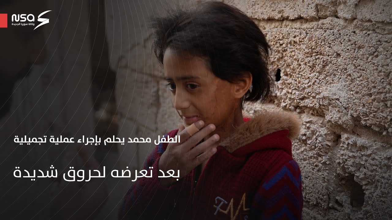 الطفل محمد يحلم بإجراء عملية تجميلية بعد تعرضه لحروق شديدة في جسده