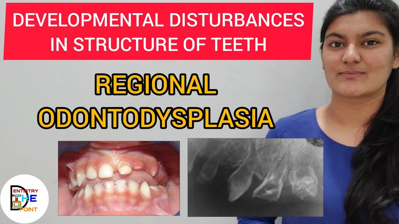 REGIONAL ODONTODYSPLASIA (GHOST TEETH) - DEVELOPMENTAL DISTURBANCES IN STRUCTURE OF TEETH