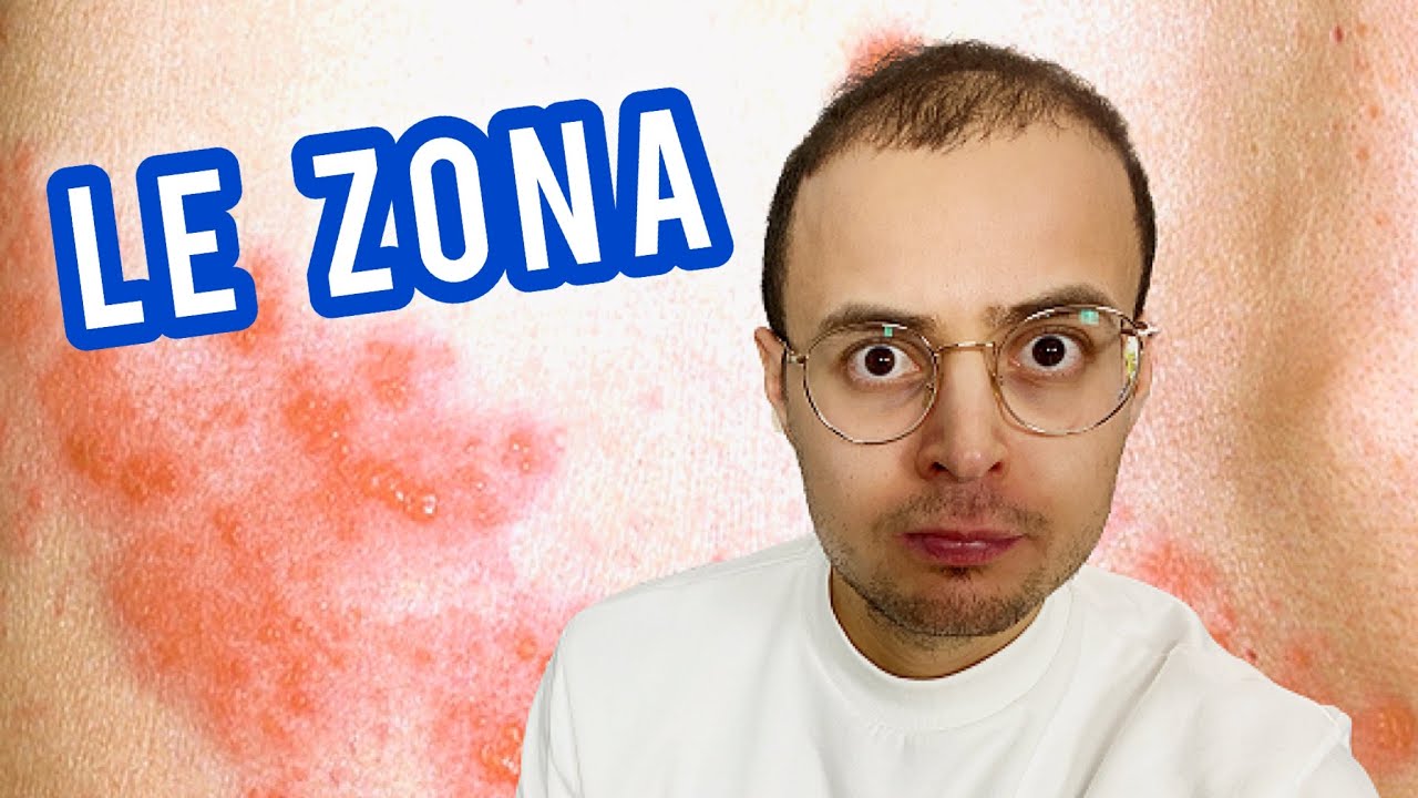 LE ZONA : une maladie très douloureuse ! 😖