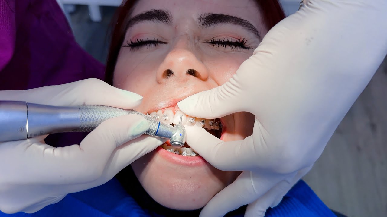 Full braces appointment- Removing a bracket