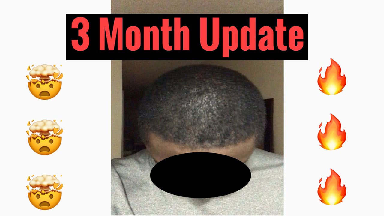 Asli Tarcan | African American | Hair Transplant | 3 Month Update