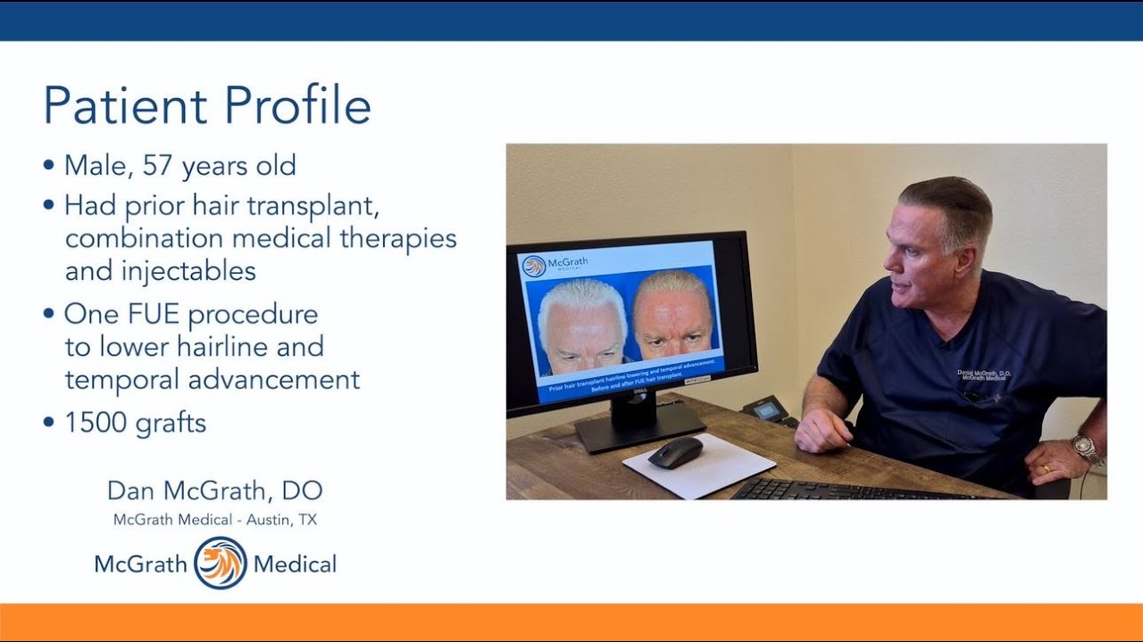 Hairline Lowering after Multiple prior Hair Transplants