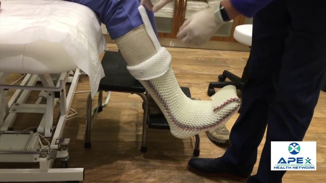 How to apply a total contact cast (TCC-EZ)