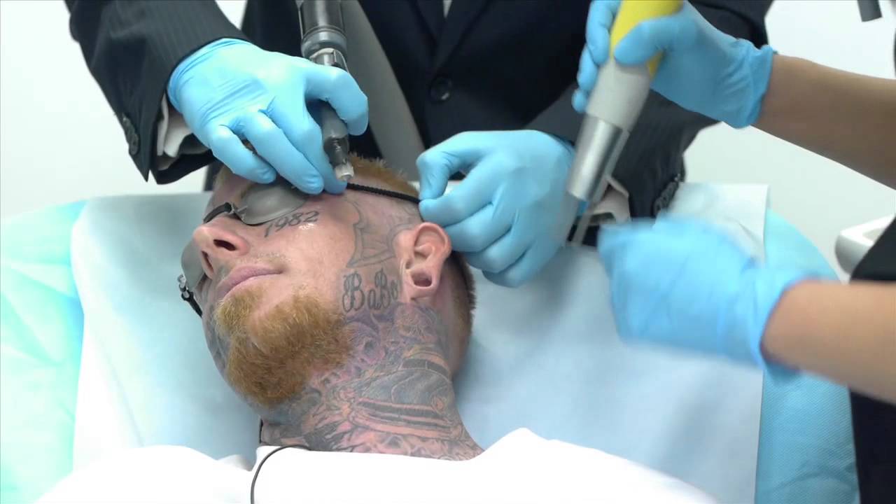 Crazy Video of Man Getting Face Tattoo Removed