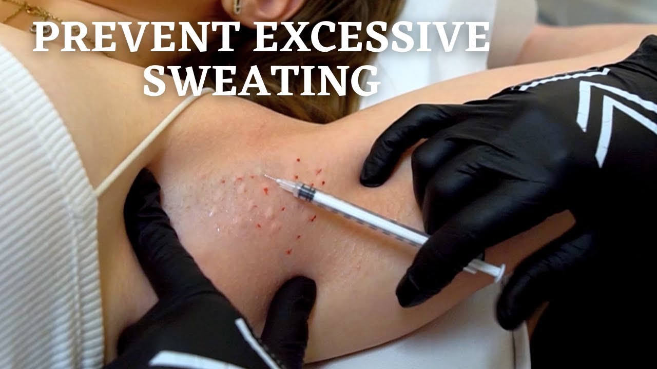How to Stop Hyperhidrosis Using Botox