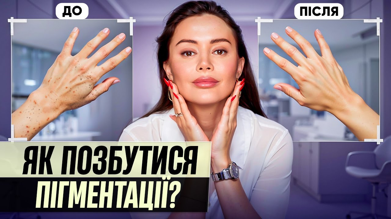 Зробіть ЦЕ і Ваша шкіра стане молодою! Як позбутися пігментних плям? / Говорить Шкіра