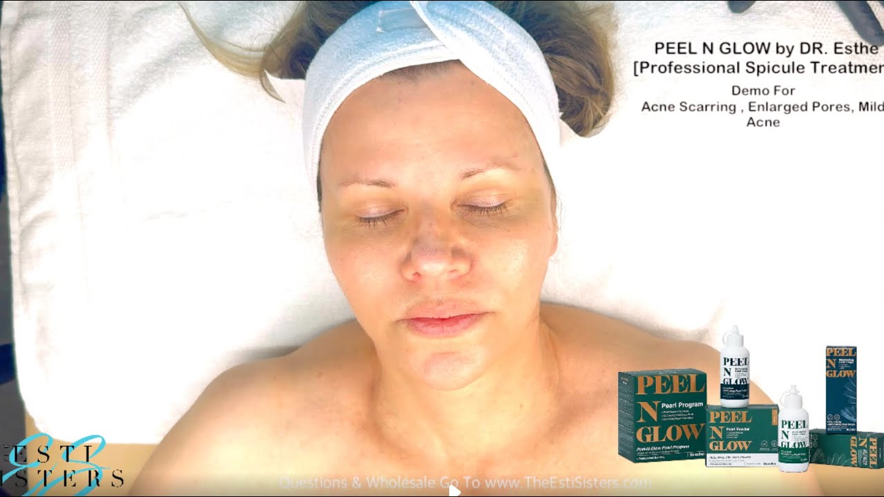 Korean Resurface + Clarify Spicule Treatment (Mild Acne and Acne Scaring/Enlarged Pores)