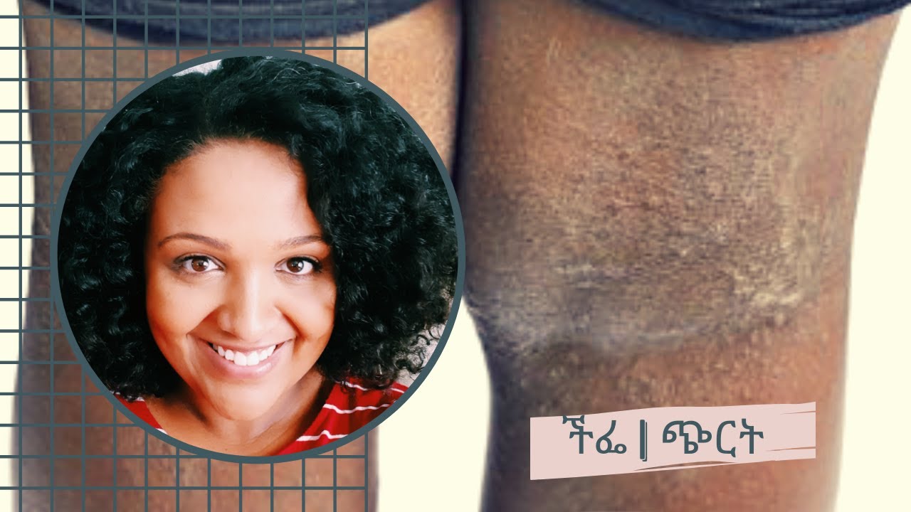 ችፌ (ጭርት) - ምንድነው መነሻው እና ማጥፍያው፧ አመጋገባችን ይወስነዋል፧