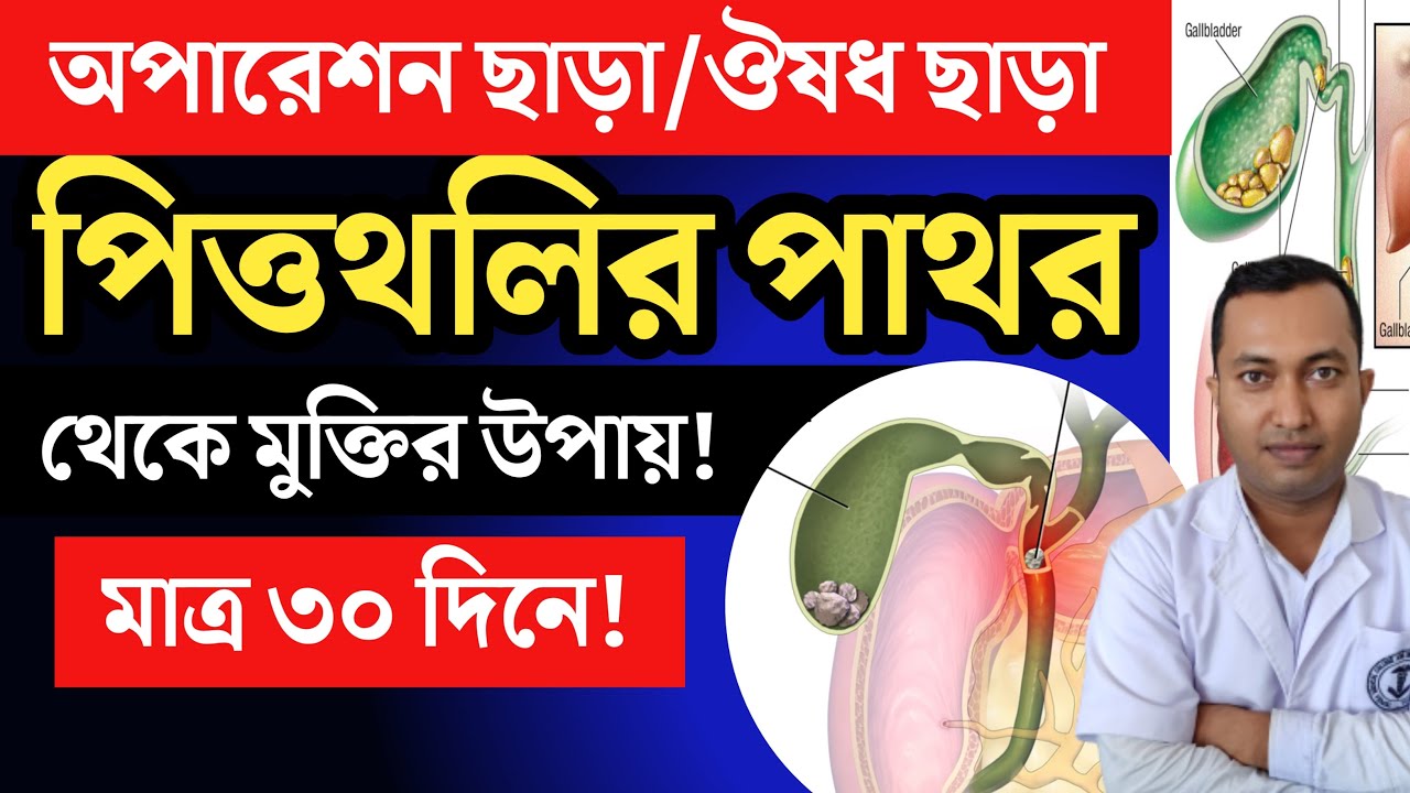 ঔষধ ছাড়া পিত্তথলির পাথর থেকে মুক্তির উপায় | গল ব্লাডার স্টোনের ঘরোয়া চিকিৎসা | Gall stone