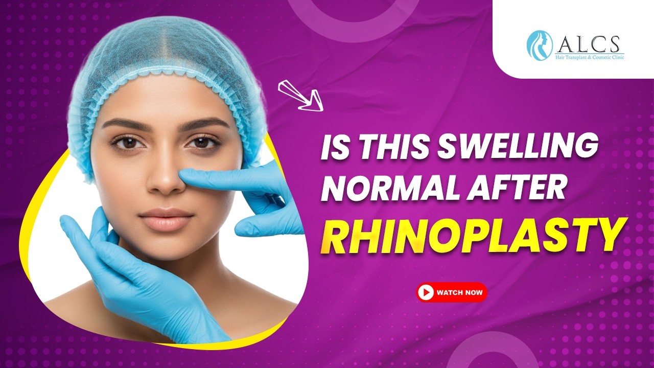 Rhinoplasty swelling explained: Normal healing vs complications | Dr. Sunil Arora