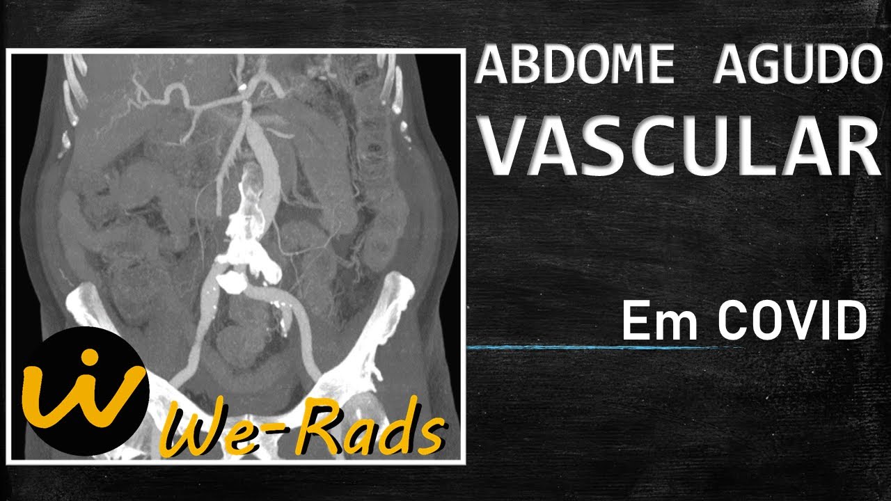 Abdome Agudo Vascular em COVID-19
