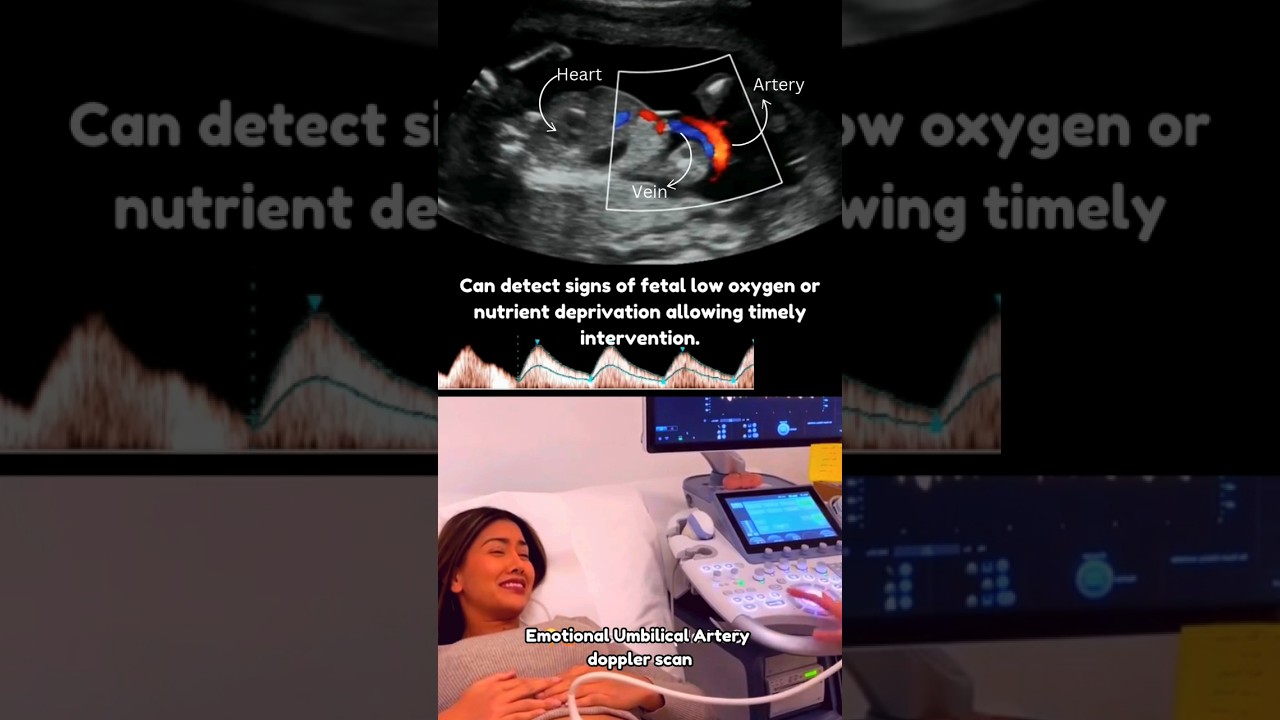 Umbilical Artery Doppler Ultrasound Scan🥰 Happy Mother