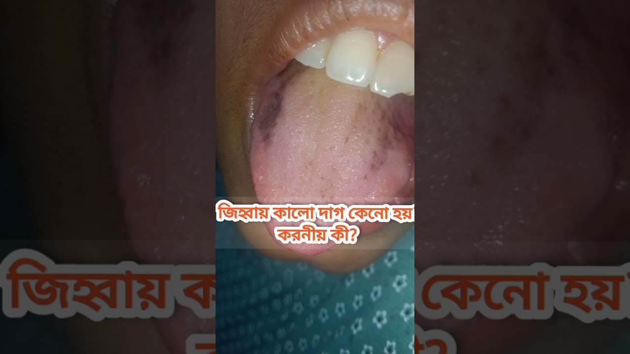 জিহ্বায় কালো দাগ হলে যা করনীয়
