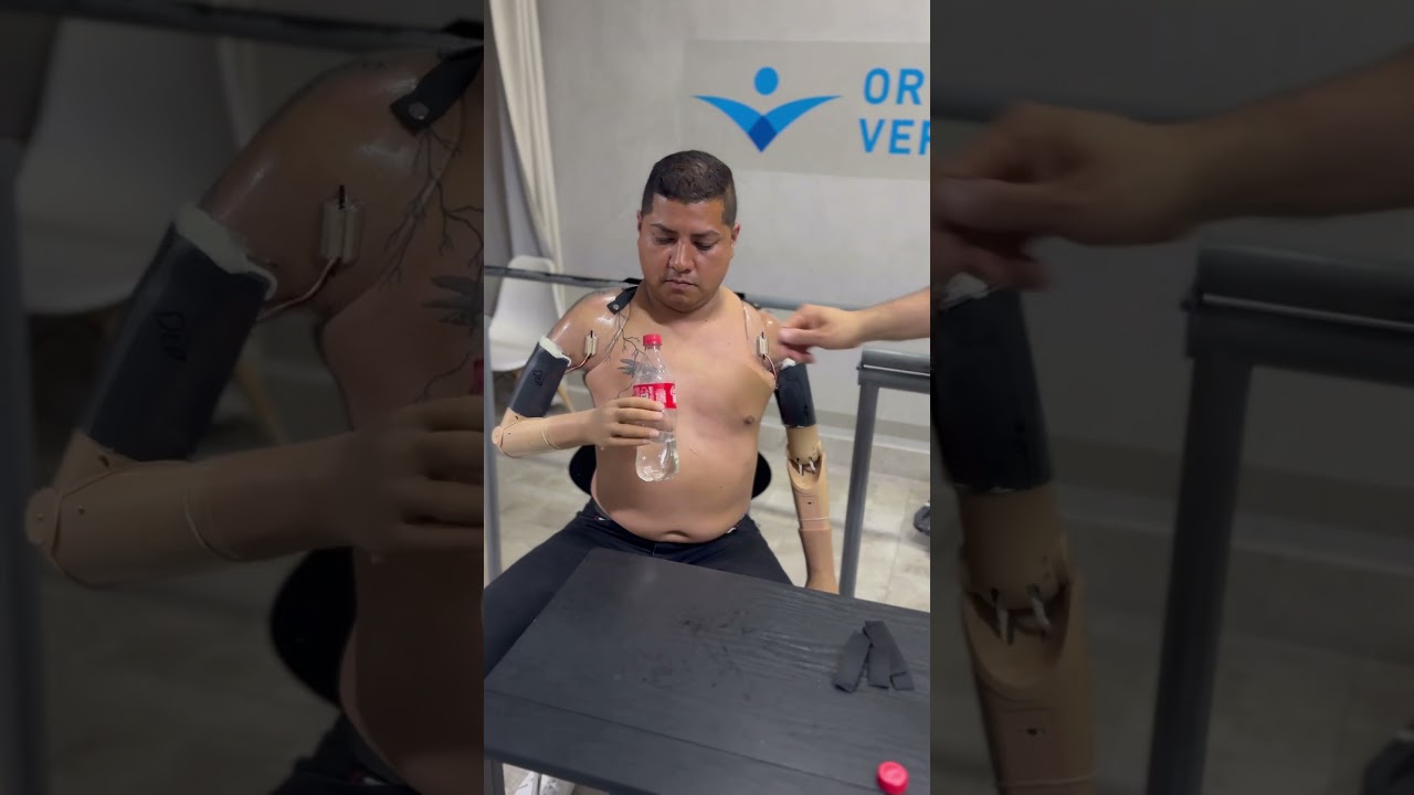Protesis de brazo m&iacute;oelectrica #pr&oacute;tesis #protesisdebrazo