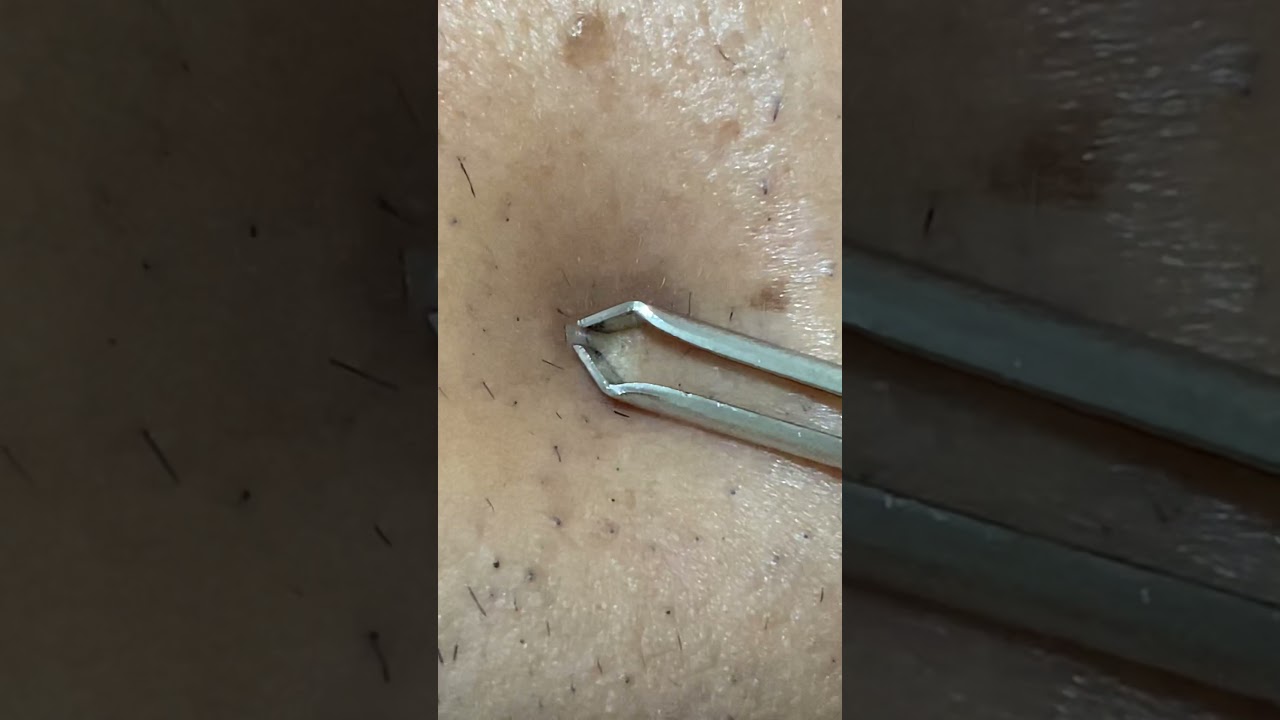satisfying ingrow hair removal / pelo encravado #ingrownhair #asmr #relax