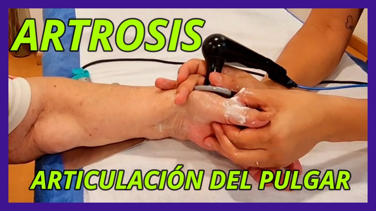 🟢RIZARTROSIS del PULGAR👍🏼Tratamiento Real elimina dolor gana movilidad dedos #fisioterapia #artrosis