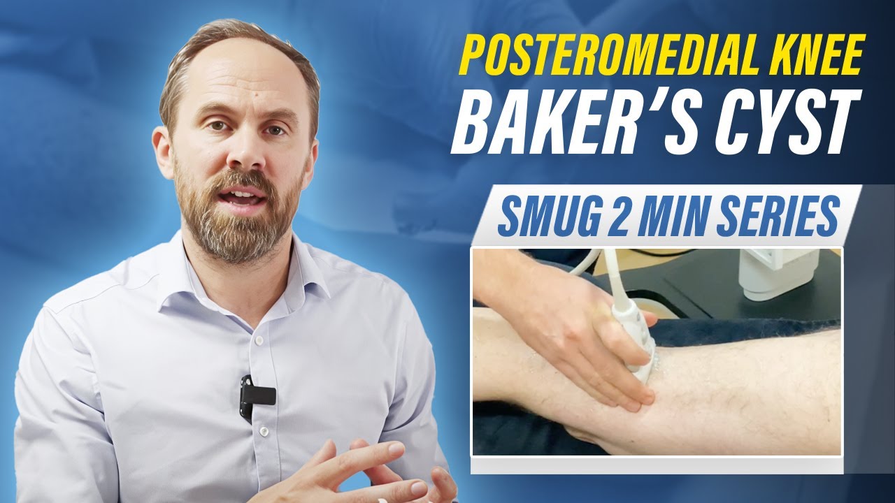 Posteromedial knee - Baker's cyst - 2 min series MSKUS