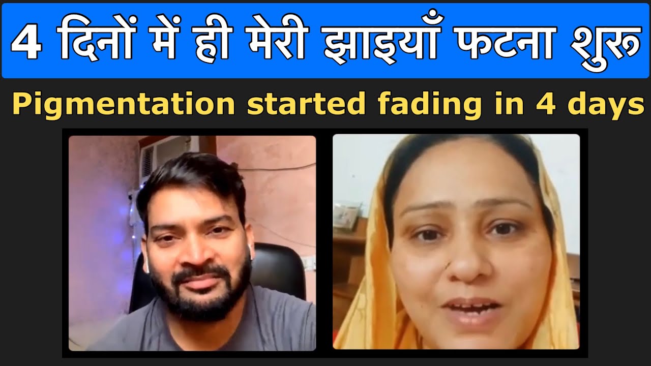 My Pigmentation started fading in just 4 days. 4 दिनों में ही मेरी झाइयाँ फटना शुरू I