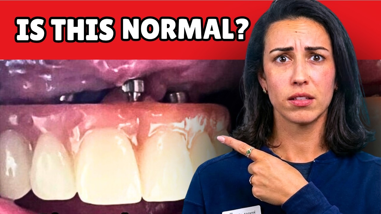 Doctor Explains the “Gap” Under Full Dental Implants
