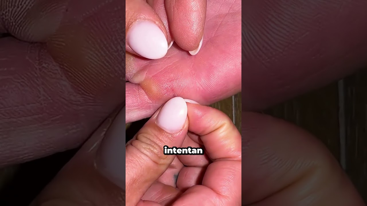 El truco m&aacute;s f&aacute;cil para quitar espinas de cactus sin dolor