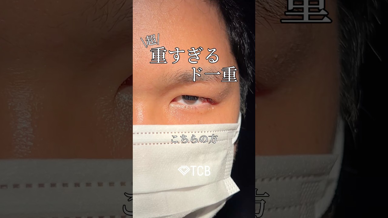 【二重整形】重たすぎるメンズ一重🐼#shorts